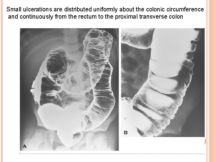 Small ulcerations are distributed uniformly about the colonic circumference and continuously from the rectum