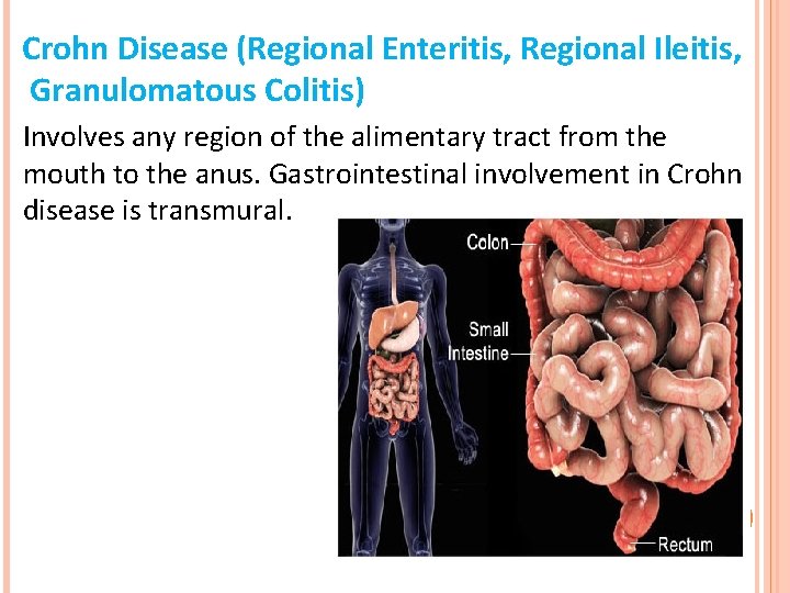 Crohn Disease (Regional Enteritis, Regional Ileitis, Granulomatous Colitis) Involves any region of the alimentary