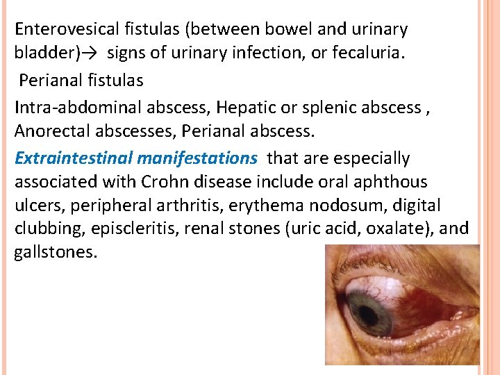 Enterovesical fistulas (between bowel and urinary bladder)→ signs of urinary infection, or fecaluria. Perianal