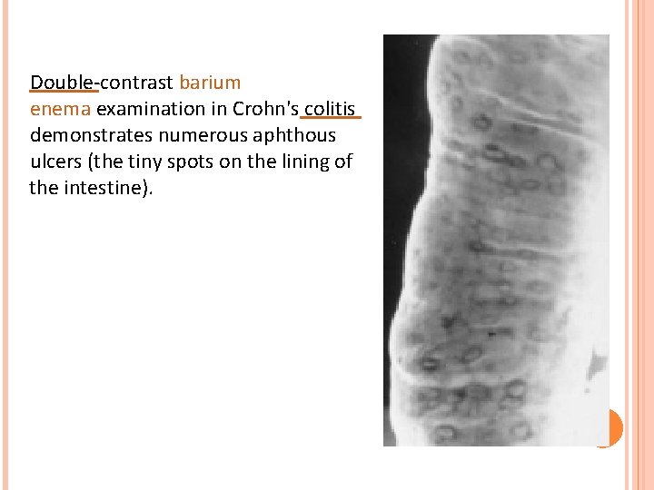 Double-contrast barium enema examination in Crohn's colitis demonstrates numerous aphthous ulcers (the tiny spots