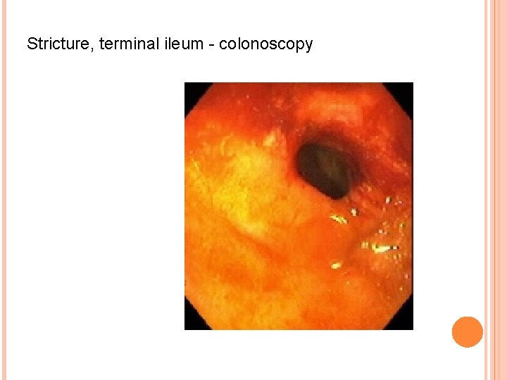 Stricture, terminal ileum - colonoscopy 