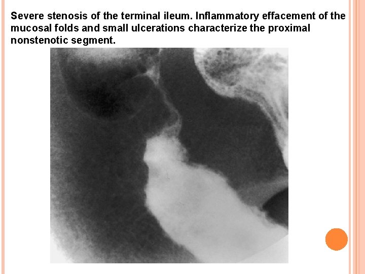 Severe stenosis of the terminal ileum. Inflammatory effacement of the mucosal folds and small