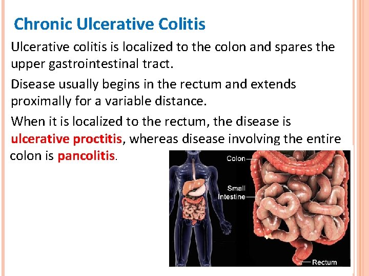 Chronic Ulcerative Colitis Ulcerative colitis is localized to the colon and spares the upper