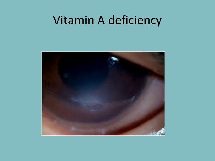 Vitamin A deficiency 
