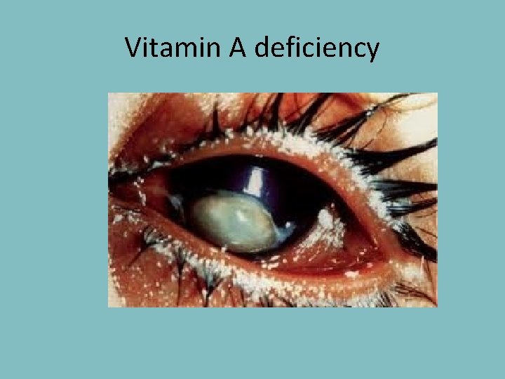 Vitamin A deficiency 