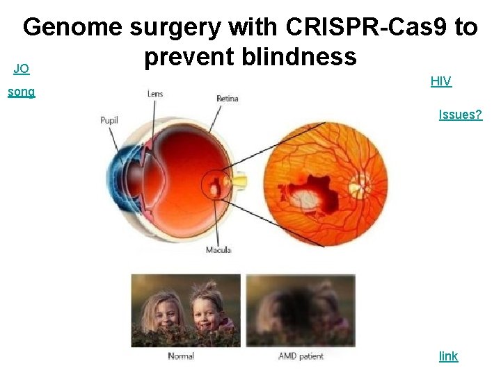 Genome surgery with CRISPR-Cas 9 to prevent blindness JO song HIV Issues? link 