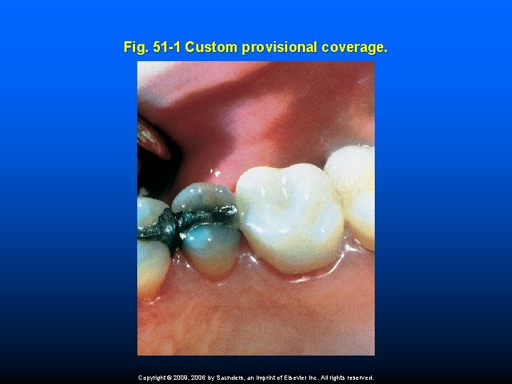 Fig. 51 -1 Custom provisional coverage. Copyright © 2009, 2006 by Saunders, an imprint Fig. 51 -1 Custom provisional coverage. Copyright © 2009, 2006 by Saunders, an imprint