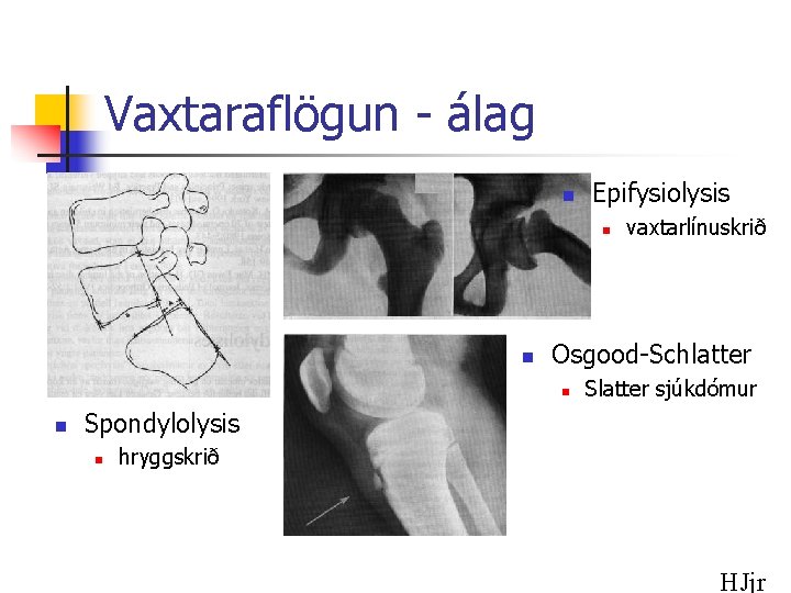 Vaxtaraflögun - álag n Epifysiolysis n n Osgood-Schlatter n n vaxtarlínuskrið Slatter sjúkdómur Spondylolysis