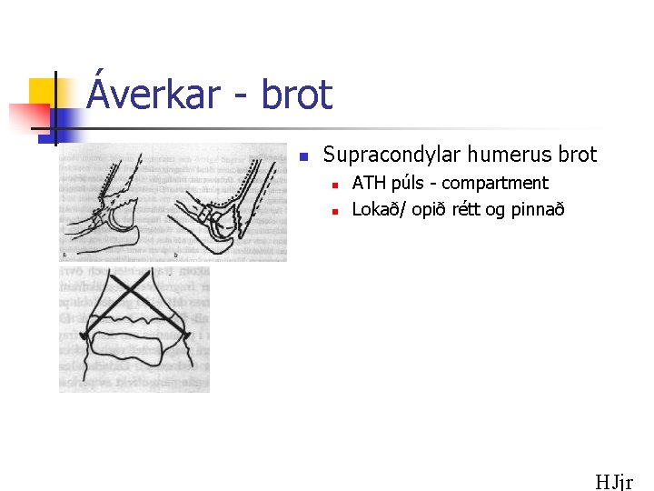 Áverkar - brot n Supracondylar humerus brot n n ATH púls - compartment Lokað/