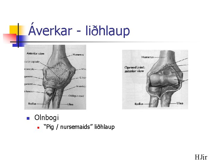 Áverkar - liðhlaup n Olnbogi n “Pig / nursemaids” liðhlaup HJjr 