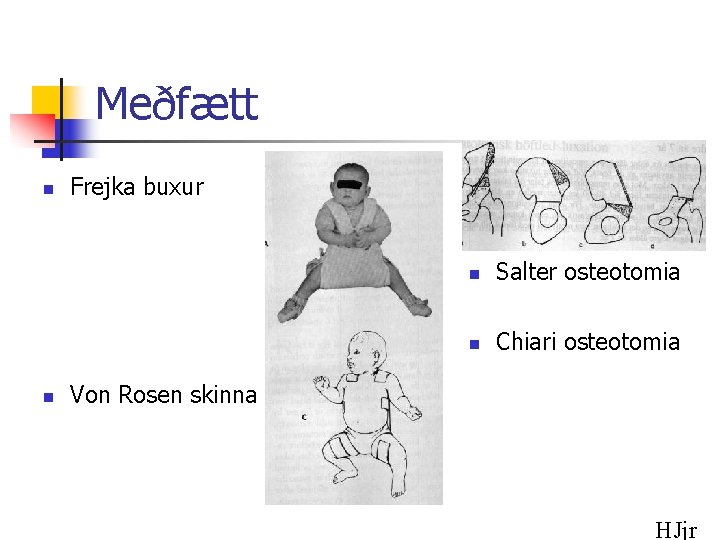 Meðfætt n n Frejka buxur n Salter osteotomia n Chiari osteotomia Von Rosen skinna