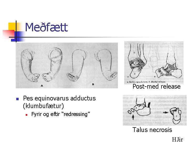 Meðfætt Post-med release n Pes equinovarus adductus (klumbufætur) n Fyrir og eftir “redressing” Talus