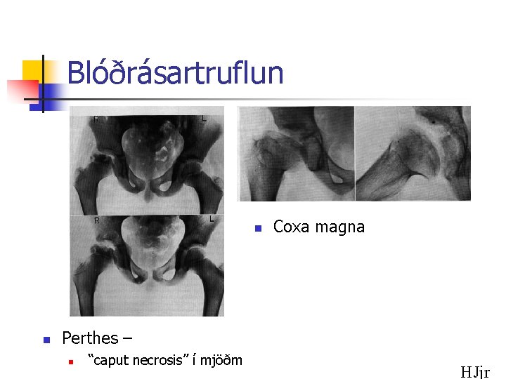 Blóðrásartruflun n n Coxa magna Perthes – n “caput necrosis” í mjöðm HJjr 