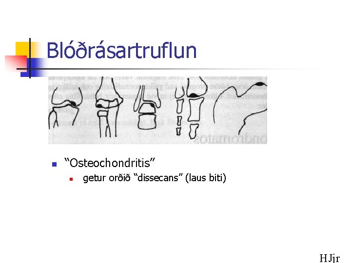 Blóðrásartruflun n “Osteochondritis” n getur orðið “dissecans” (laus biti) HJjr 