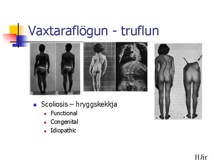 Vaxtaraflögun - truflun n Scoliosis – hryggskekkja n n n Functional Congenital Idiopathic HJjr
