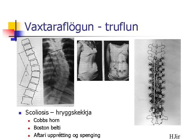 Vaxtaraflögun - truflun n Scoliosis – hryggskekkja n n n Cobbs horn Boston belti