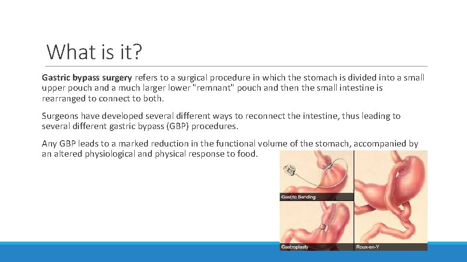 What is it? Gastric bypass surgery refers to a surgical procedure in which the