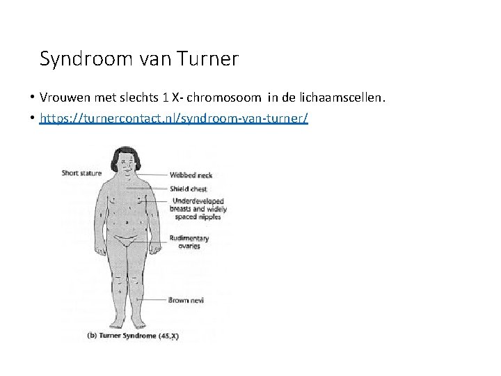 Syndroom van Turner • Vrouwen met slechts 1 X- chromosoom in de lichaamscellen. •