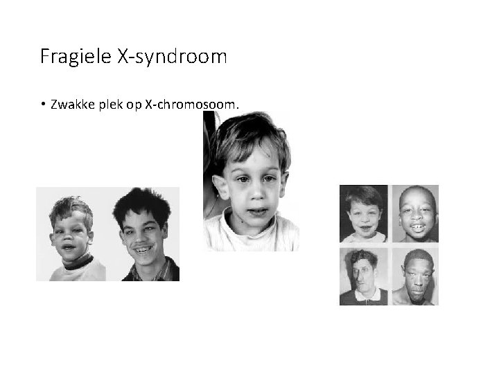 Fragiele X-syndroom • Zwakke plek op X-chromosoom. 