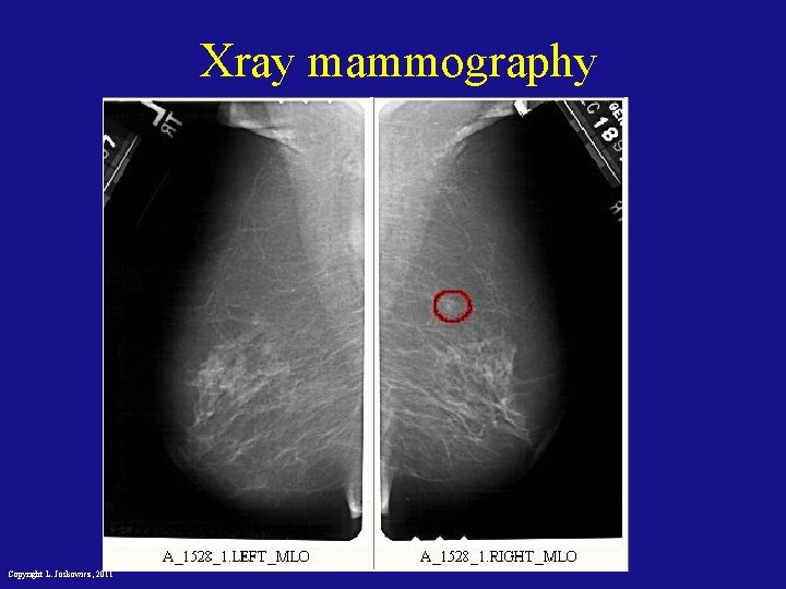 Xray mammography Copyright L. Joskowicz, 2011 