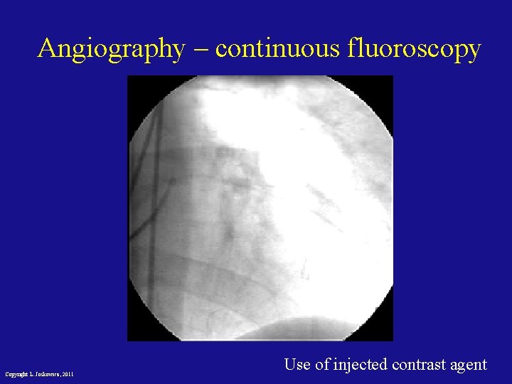 Angiography – continuous fluoroscopy Copyright L. Joskowicz, 2011 Use of injected contrast agent 