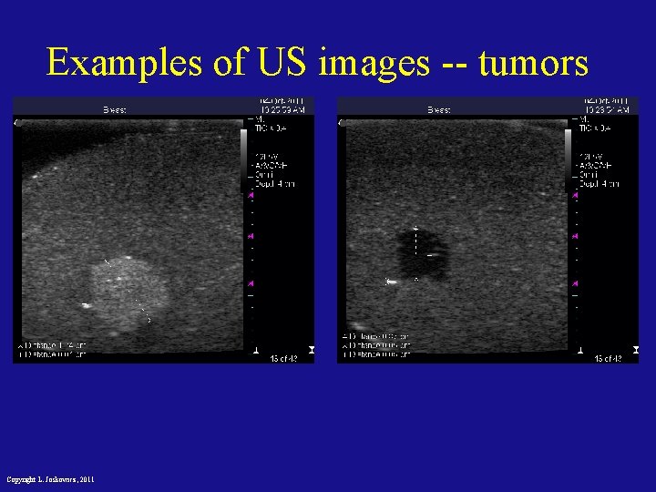 Examples of US images -- tumors Copyright L. Joskowicz, 2011 