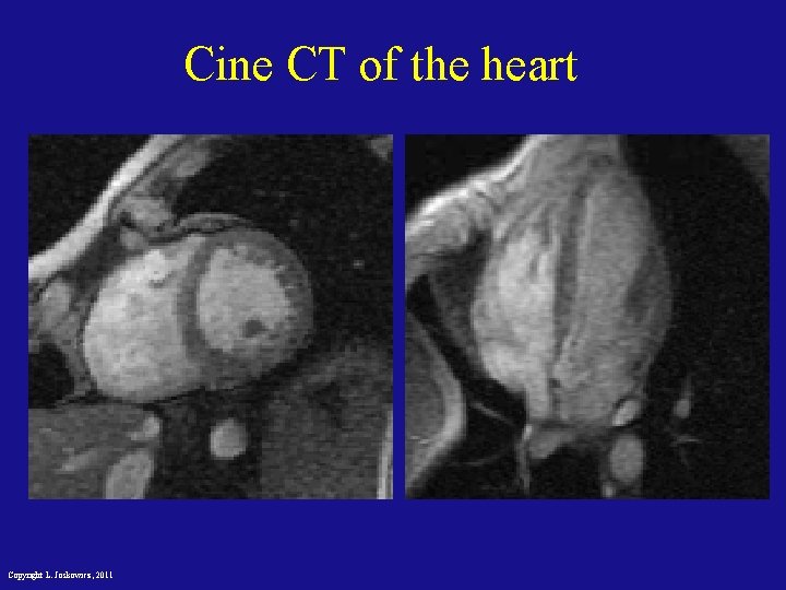 Cine CT of the heart Copyright L. Joskowicz, 2011 