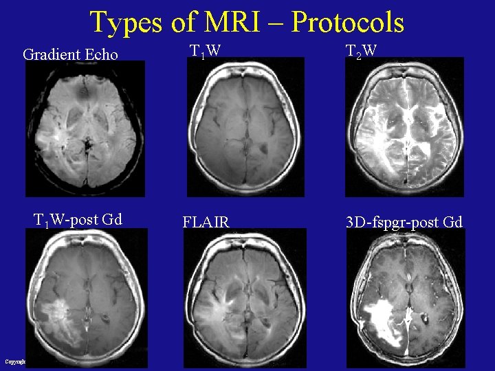 Types of MRI – Protocols Gradient Echo T 1 W-post Gd Copyright L. Joskowicz,