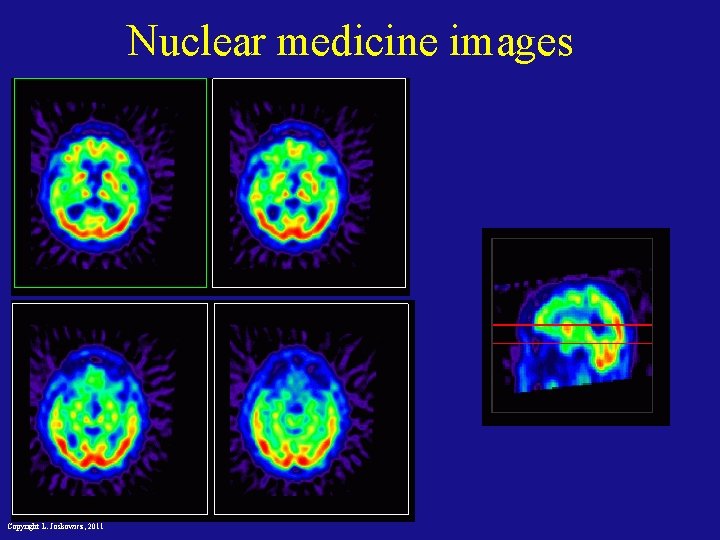 Nuclear medicine images Copyright L. Joskowicz, 2011 