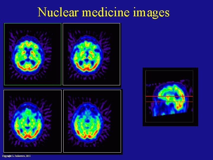 Nuclear medicine images Copyright L. Joskowicz, 2011 