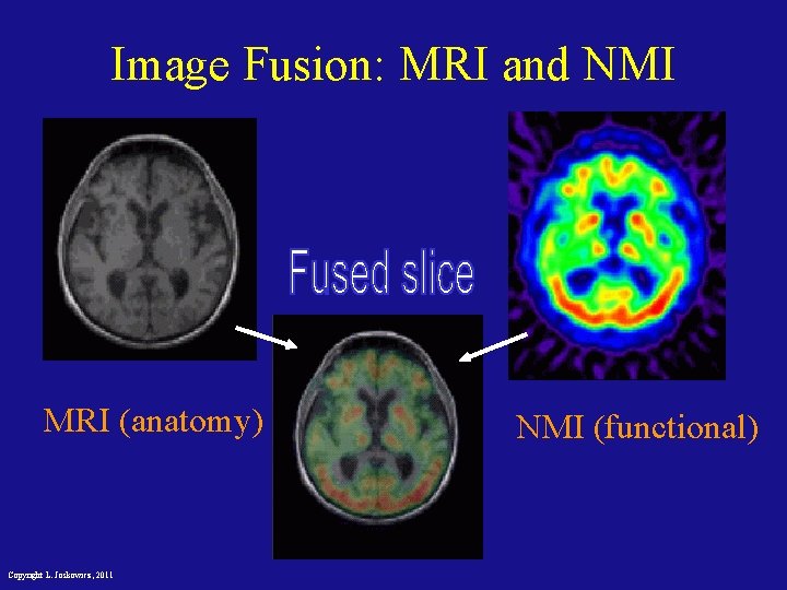 Image Fusion: MRI and NMI MRI (anatomy) Copyright L. Joskowicz, 2011 NMI (functional) 