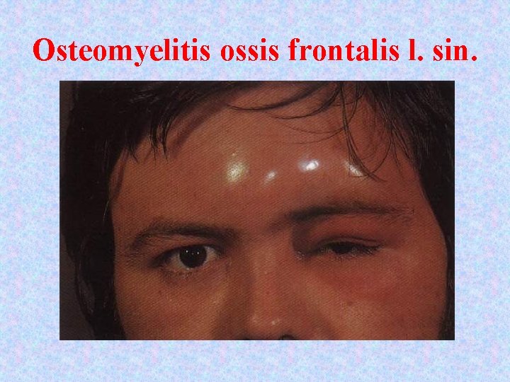 Osteomyelitis ossis frontalis l. sin. 