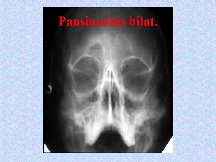 Pansinusitis bilat. 