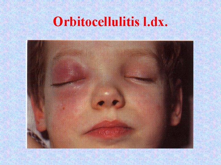 Orbitocellulitis l. dx. 