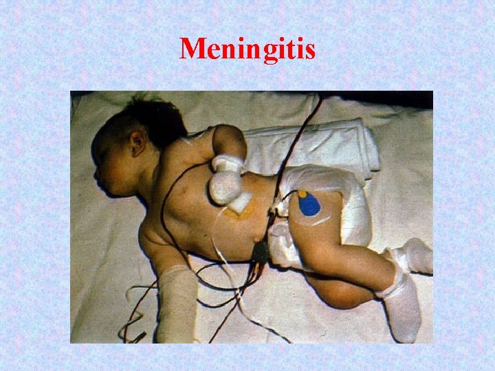 Meningitis 