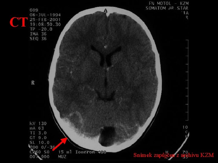 CT Snímek zapůjčen z archivu KZM 