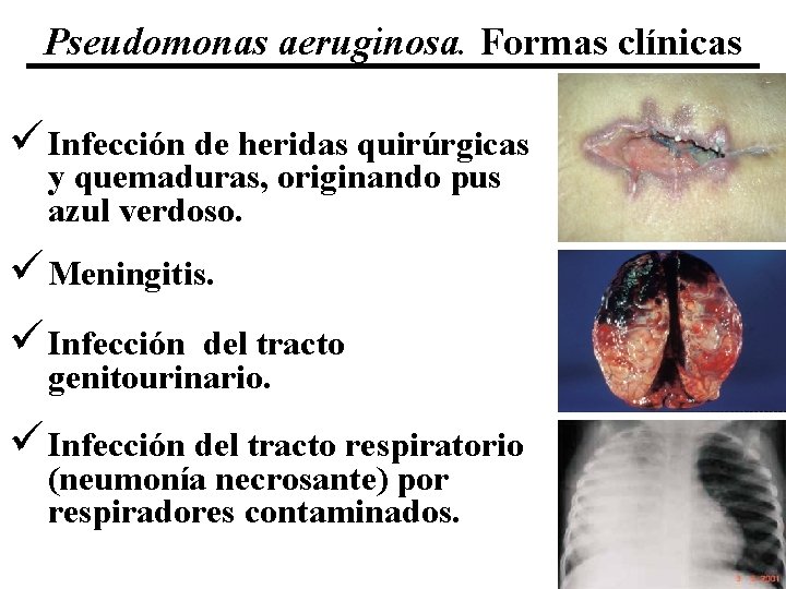 Pseudomonas aeruginosa. Formas clínicas ü Infección de heridas quirúrgicas y quemaduras, originando pus azul