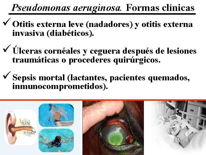 Pseudomonas aeruginosa. Formas clínicas ü Otitis externa leve (nadadores) y otitis externa invasiva (diabéticos).