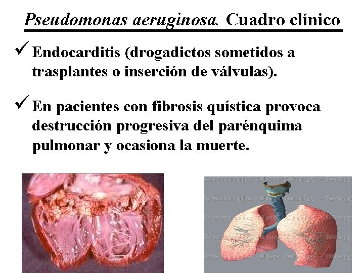 Pseudomonas aeruginosa. Cuadro clínico ü Endocarditis (drogadictos sometidos a trasplantes o inserción de válvulas).