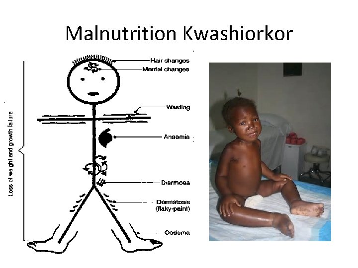 Malnutrition Kwashiorkor 