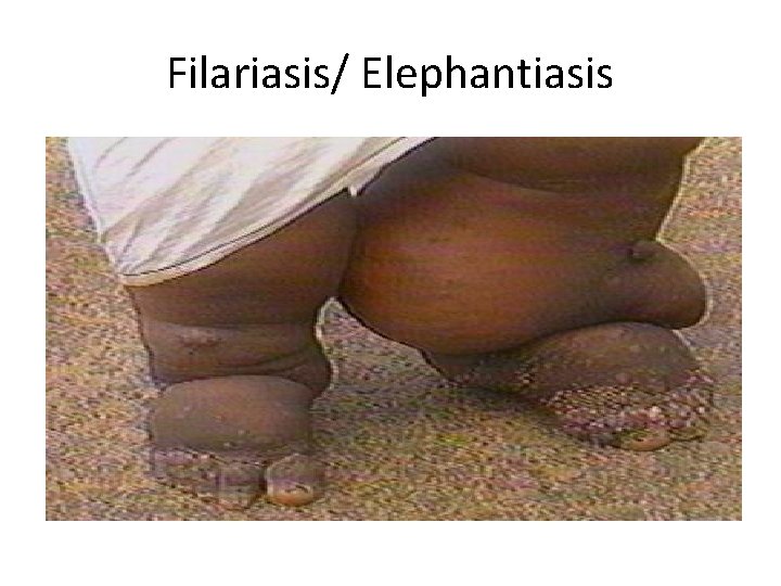 Filariasis/ Elephantiasis 