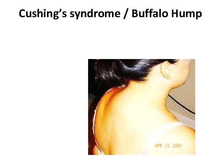 Cushing’s syndrome / Buffalo Hump 