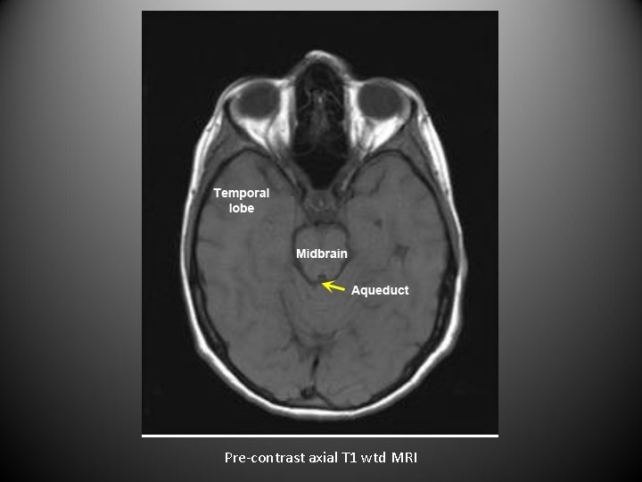 Pre-contrast axial T 1 wtd MRI 