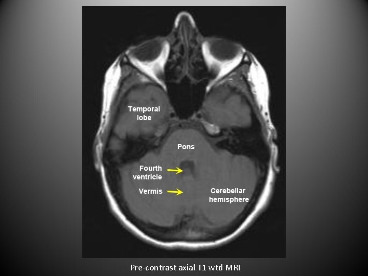 Pre-contrast axial T 1 wtd MRI 