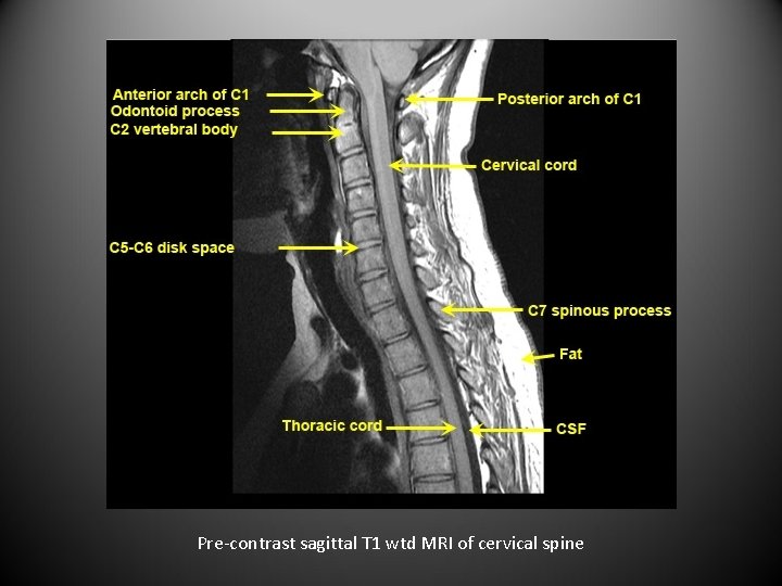 Pre-contrast sagittal T 1 wtd MRI of cervical spine 