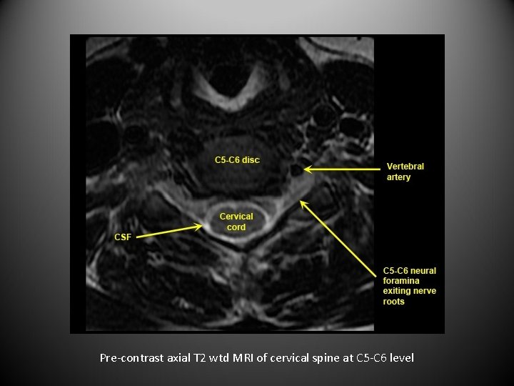 Pre-contrast axial T 2 wtd MRI of cervical spine at C 5 -C 6
