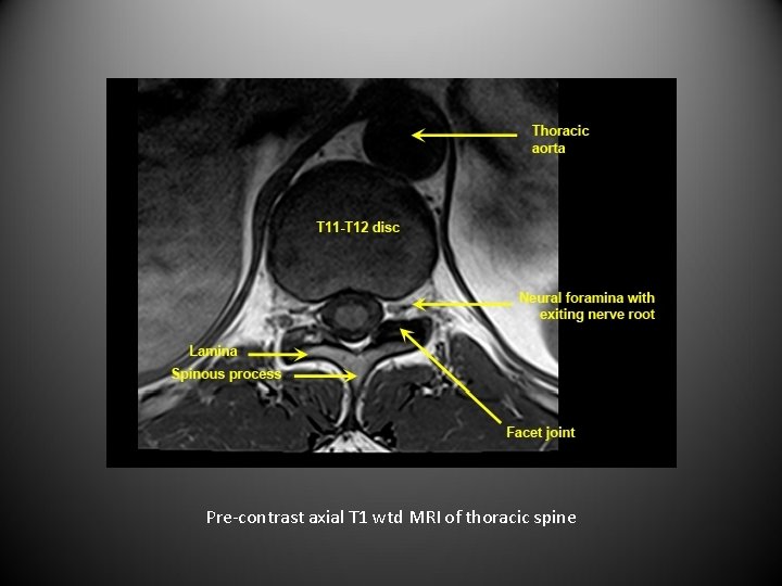 Pre-contrast axial T 1 wtd MRI of thoracic spine 