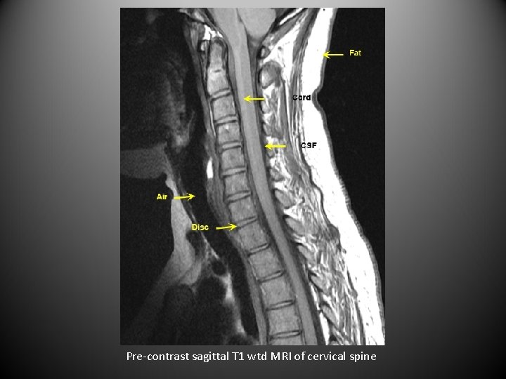 Pre-contrast sagittal T 1 wtd MRI of cervical spine 