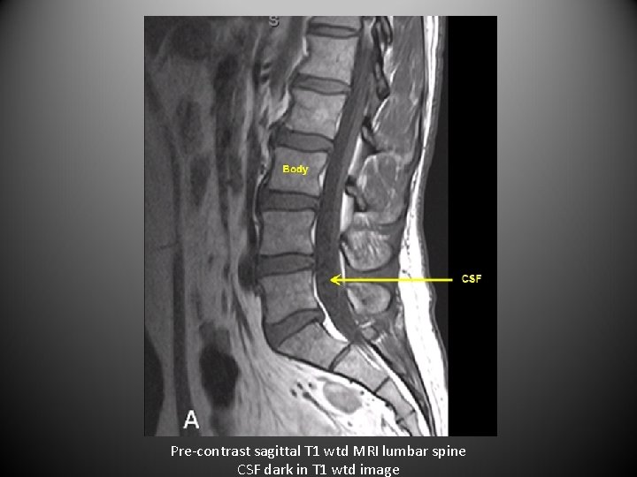 Pre-contrast sagittal T 1 wtd MRI lumbar spine CSF dark in T 1 wtd