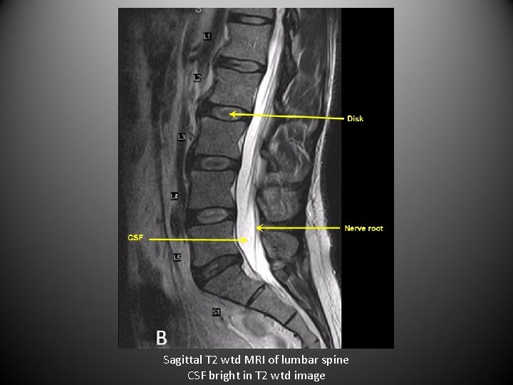 Sagittal T 2 wtd MRI of lumbar spine CSF bright in T 2 wtd
